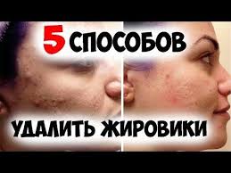 как избавиться от грибка в ухе в домашних условиях Kak Izbavitsya Ot Zhirovikov 5 Sposobov Udalit Zhirovik V Domashnih Usloviyah Profilaktika Youtube Detoks Kozhi Tovary Dlya Zdorovya Lichnaya Gigiena