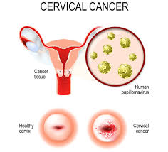 Cin 3 has a higher risk of developing into cervical cancer. Business Kinopharma Inc