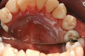 Image result for gums cancer symptoms