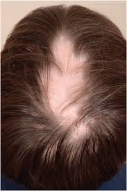 The scalp is the most commonly affected area, although patients commonly report the loss of hair. Eosinophilic Esophagitis Another Atopy Related Alopecia Areata Trigger Sciencedirect