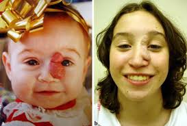 Medical involvement is really not helpful and not indicated in the treatment of these lesions. 8 Treatment Of Infantile Hemangiomas Ento Key