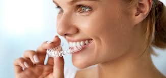 Invisalign Clear Aligners