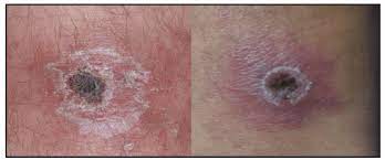 Diagnosis And Management Of Tickborne Rickettsial Diseases Rocky Mountain Spotted Fever And Other Spotted Fever Group Rickettsioses Ehrlichioses And Anaplasmosis United States Mmwr