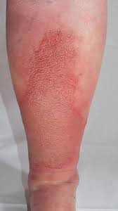 Image result for erysipel photos)