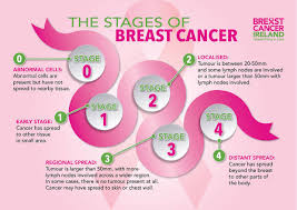 Breast cancer cells can spread to other parts of the body and grow there the stage describes the spread of the cancer through the breast. The Stages Of Breast Cancer Breast Cancer Ireland Facebook