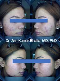 Photodynamic Therapy (PDT) for acne which have very low recurrence rate  after treatment. You can visit me or inbox me for more detail information.