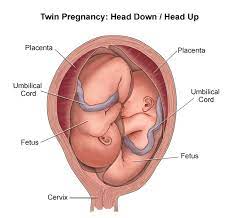 Breech Birth Wikipedia