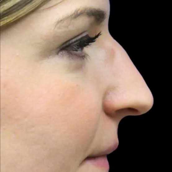 Best Liquid Facelift NYC | Dr. Jennifer Levine