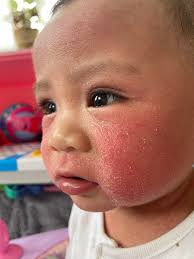 Hi all, My daughter has this rash (at least what ped is calling it)