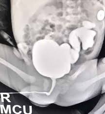 Image result for Voiding Cystourethrogram