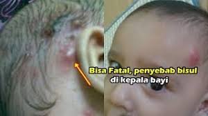 Bisul adalah benjolan berisi nanah yang disebabkan infeksi bakteri. Penyebab Bisul Di Kepala Bayi Dan Cara Mengatasinya Youtube
