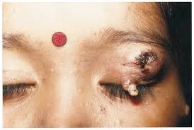 Image result for cornu cutaneum)