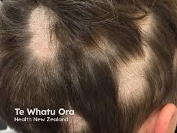 Image result for Tinea Capitis