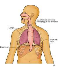 Mar 13, 2015 · enhanced recovery (er) pathways have become the established standard of care in many areas of gastrointestinal (gi) surgery. Cancer Of The Oesophagus Surgery Abeezar Sarela