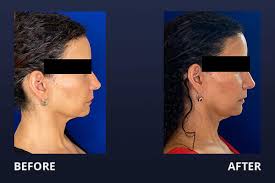 Maybe you would like to learn more about one of these? Botox Before After Pictures Madnani Facial Plastic Surgery