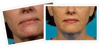 This makes your veins more visible and prominent. Michigan Facial Spider Veins Treatment Skin And Vein Center