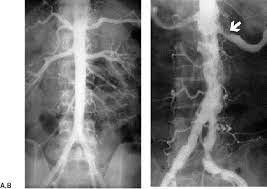 Atherosclerotic Disease Of The Aorta Pelvis And Lower Extremities Radiology Key