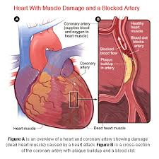 Complete blockage of a carotid artery. Coronary Artery Disease Cad Is The Most Common Type Of Heart Disease And The Leading Cause Of Death In The United States In Both Men And Women