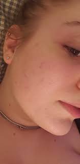 We did not find results for: Skin Concern Any Tips On Healing Ice Pick Scars Skincareaddiction