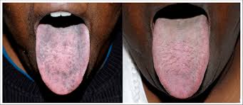 Image result for black tongue symptoms