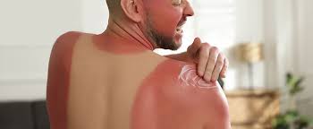 Image result for Sunburn