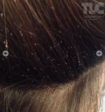 Nits are glued to the strands of hair and can appear translucent or brownish in color. Facebook