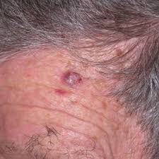 Skin cancer is the most common form of cancer in the united states. Basal Cell Carcinoma Of The Skin Ors Plastic Surgery