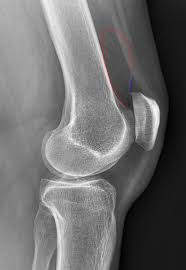 Image result for Knee XRay