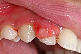 Image result for dental cancer