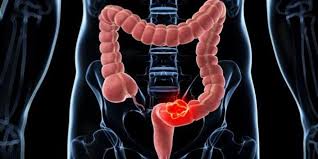 It extends from the end of the small bowel to the rectum; Colon Cancer These Are The Warning Symptoms And So You Can Prevent It Archyde