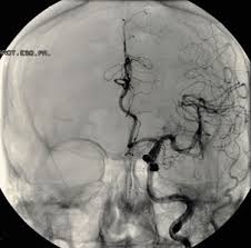 Cerebral Aneurysm Johns Hopkins Medicine However, a number of factors are believed to contribute to the formation of cerebral.