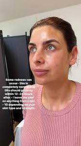 Today I tried out my #Medik8 REWIND peel. And I am impressed with the  result- my beautiful model had glowing skin after. I forgot to take a  before but will show on