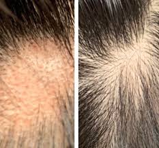 Injected into the right kind of pimple—there is a right kind; On Aip For Alopecia Areata 70 Days On Aip Diet No Cortisone Shots Autoimmuneprotocol