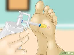 However you may need to use a concentration of up to 40% salicylic acid on some plantar warts. 5 Ways To Remove Verrucas Wikihow