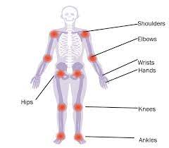 Joints And Crohn S And Colitis Crohn S Colitis Uk