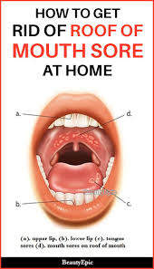 5 Simple Ways To Get Rid Of Roof Of Mouth Sore At Home Mouth Sores Roof Of Mouth Sore Mouth Blister Remedy