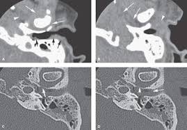 Image result for Necrotizing Otitis Externa