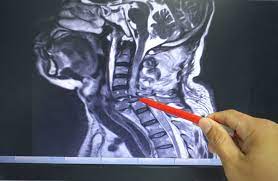 Mri (magnetic resonance imaging) is a test that uses a . Cervical Spine Curve And Injuries