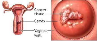 Maybe you would like to learn more about one of these? Mencegah Kanker Serviks Rumah Sakit Rkz Surabaya