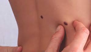 It's very common after pregnancy when a woman's. How To Remove Skin Tags Causes And More