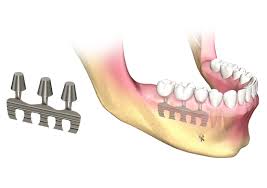 What type of dentist does implants. Dental Implant Types