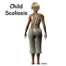 With someone observing from behind, this asymmetry in the back that can usually be found in the rib cage or hips and may be a sign that you have scoliosis. Patient Education Concord Orthopaedics