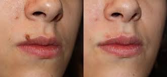 Mole Removal In Dubai Mole Removal Laser Skin Care Laser Mole Removal