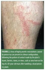 Image result for Rhus Dermatitis