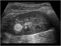 Urinary Tract And Male Reproductive System 2 1 Kidney And Ureter Case 2 1 2 Benign Renal Tumors Thyroid Ultrasound Ultrasound Sonography Sonography