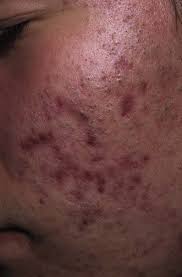 Some of the influencing factors that contribute to treatment challenges include poor adherence, inadequate therapy, and diagnostic mimics. Acne Vulgaris Clinical Gate
