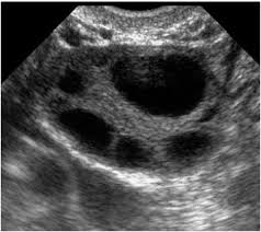 What You Aim To See Every Ultrasound Appointment Lovely Follicles Infertility Quiste En El Ovario Tratamientos Curas
