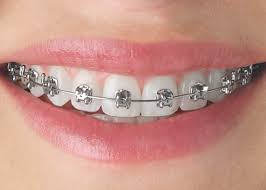 Sedangkan jika dilihat dari harganya, harga tambal gigi berbahan dasar dari logam jauh lebih murah dibandingkan dengan bahan dari porselen. Harga Braces Pendakap Gigi Di Malaysia