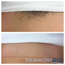 I took a deep breath and tried it. Brazilian Laser Hair Removal Doesn T Have To Be Embarrassing Blue Water Spa Aesthetic Laser Center