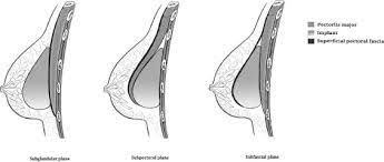 10 best breast implants of june 2021. A Comparative Assessment Of Three Planes Of Implant Placement In Breast Augmentation A Bayesian Analysis Journal Of Plastic Reconstructive Aesthetic Surgery